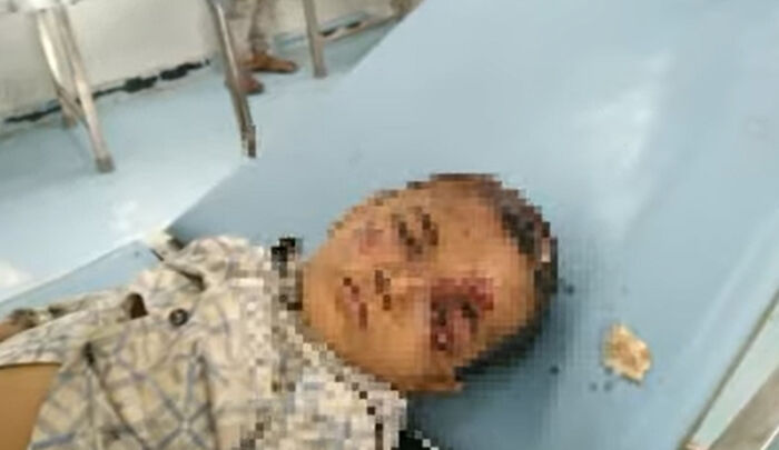 إصابة طفل بشظايا قذيفة حوثية في مديرية جبل راس