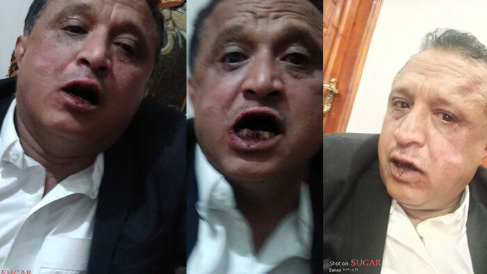 محاولة حوثية للتغطية على جريمة الاعتداء على الصحفي مجلي الصمدي