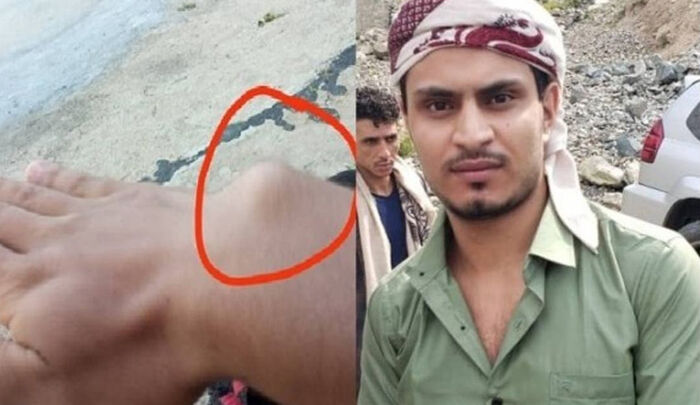 معتقل سابق بسجون الحوثي: عذبوني بوحشية لمدة 5 سنوات
