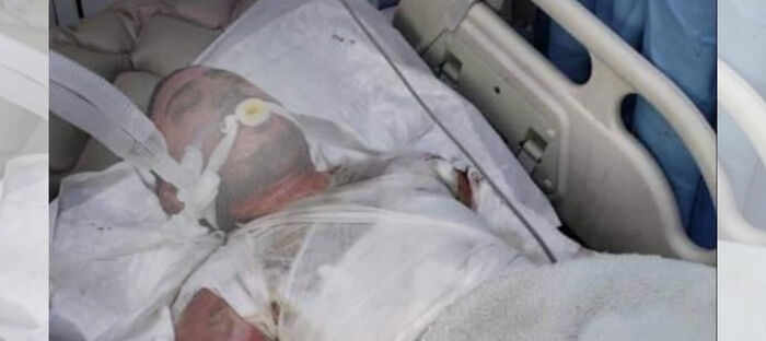 حوثيون يحرقون مواطناً بعد رشه بالبنزين